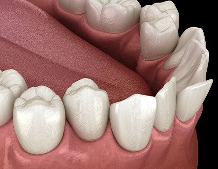 Illustration of crooked teeth