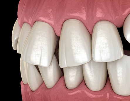 Illustration of gapped teeth
