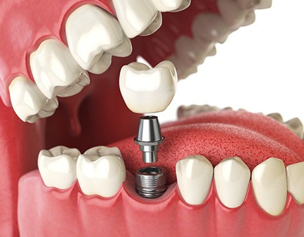 Dental implant abutment in Lewisville