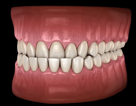 Illustration of an underbite
