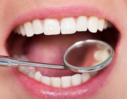 Teeth examined with dental mirror