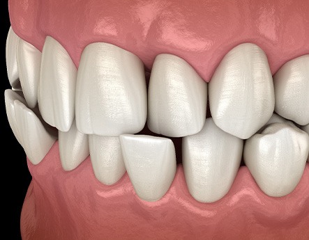 Illustration of a crossbite