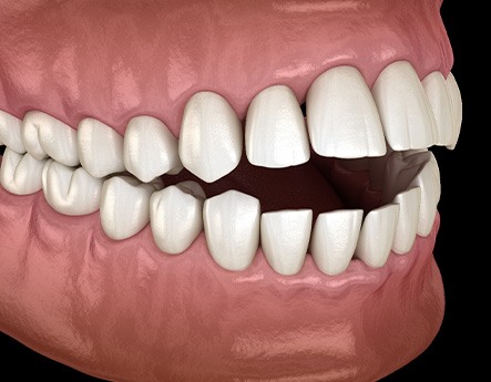 Illustration of an open bite