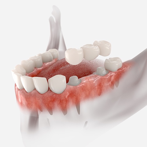 Illustration of a dental bridge