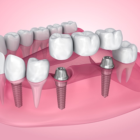 Illustration of an implant bridge