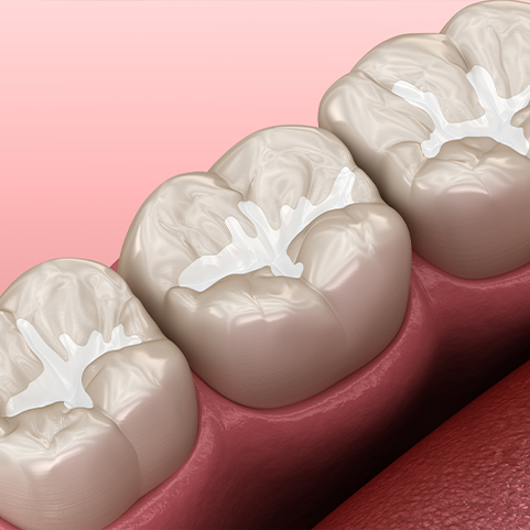 Animated smile with dental sealants