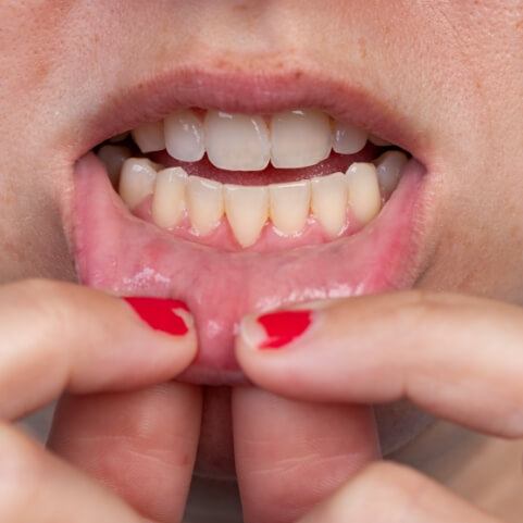 Closeup of smile after frenectomy