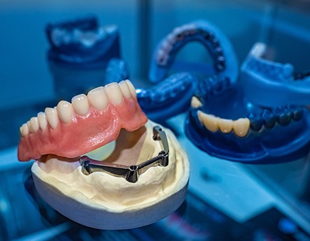 Dentures patient in Lewisville asking about implanted dentures