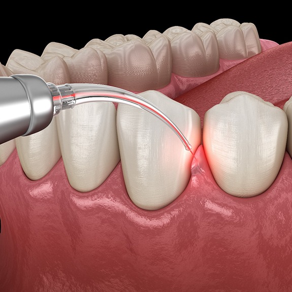 Laser treatment for gum disease in Lewisville, TX