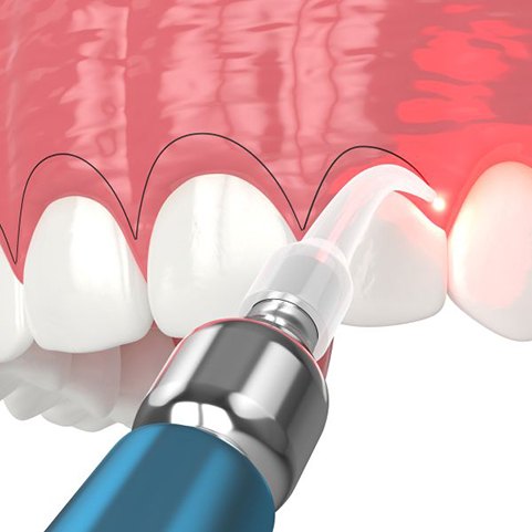 Illustration of dental laser being used during gum recontouring procedure