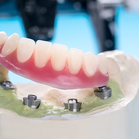 a close-up of implant dentures