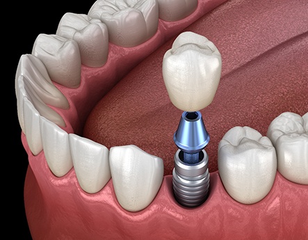 Illustration of single dental implant