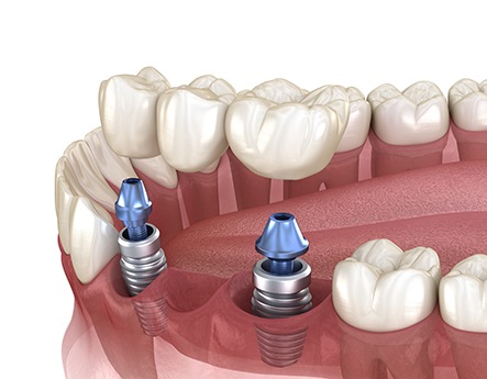 Illustration of implant bridge