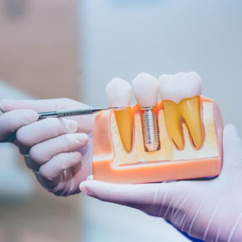 Model comparing natural teeth to dental implant supported replacement tooth