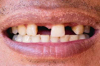 Smile with several missing teeth