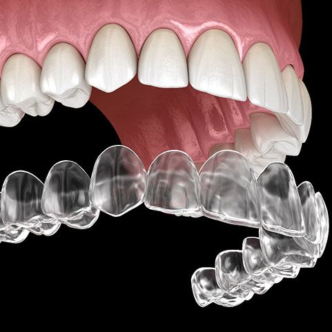 illustration for Invisalign in Lewisville 