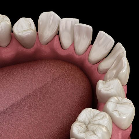 crooked teeth illustration for Invisalign in Lewisville 