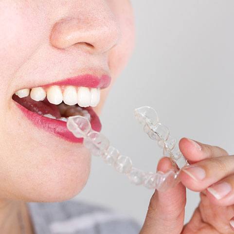 woman taking out Invisalign in Lewisville 