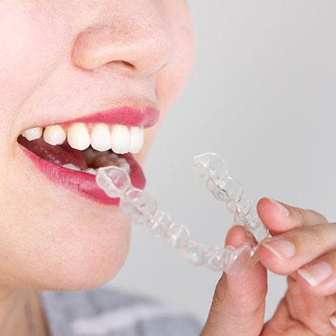 woman taking out Invisalign in Lewisville