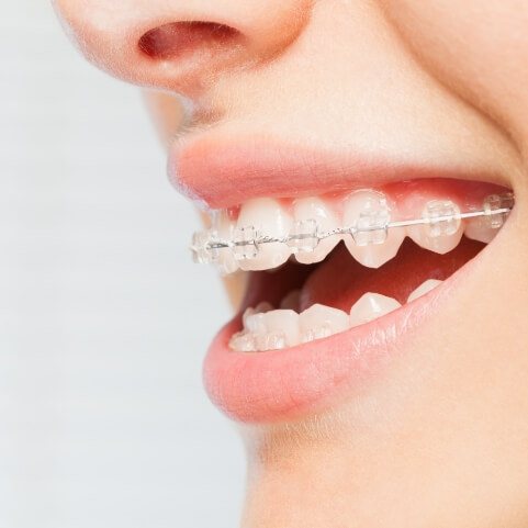 Closeup of smile with clear braces