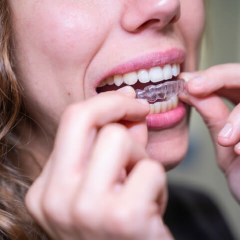 Dental patient placing sureSmile clear aligner