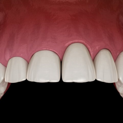 Animated smile with uneven gum line before gingivectomy