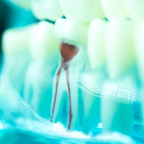 Model tooth showing results of root canal therapy