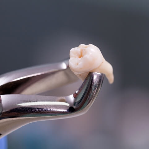 Metal clasp holding a tooth after extraction