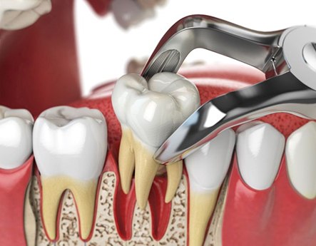 Illustration of forceps being used to extract tooth