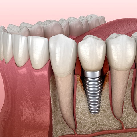 Illustration of bone loss around failed dental implant in Lewisville, TX