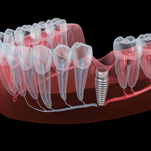 Illustration of a failed dental implant in the lower arch