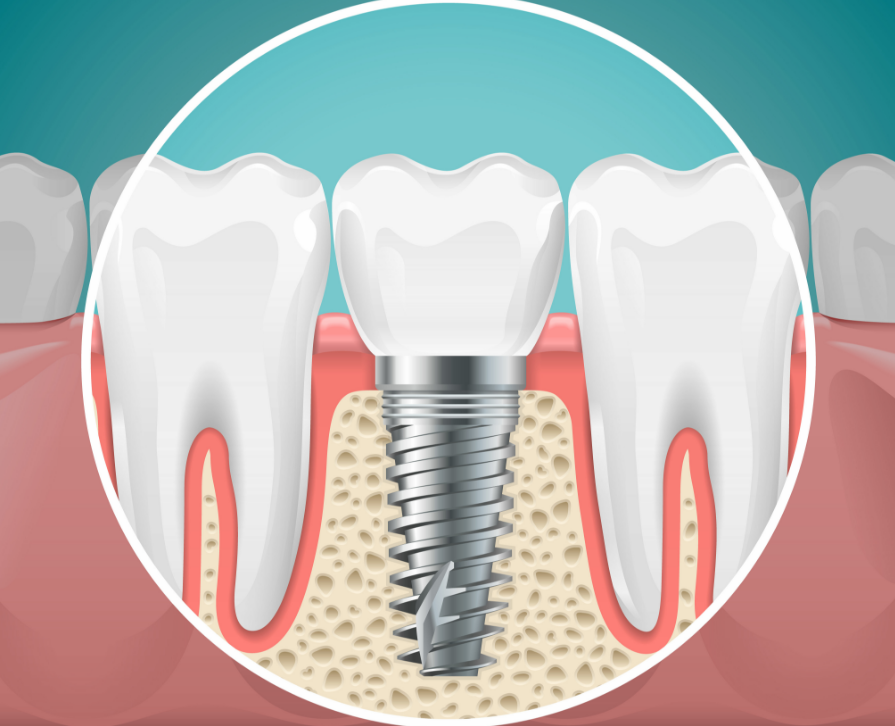 Dental implant illustration